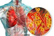  هر آنچه که باید درباره بیماری ذات الریه بدانیم