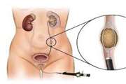 آشنایی‌ با عمل‌ جراحی‌ TUL ( شکستن‌ سنگ‌ از طریق‌ مجاری‌  ادراری‌)