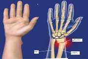 دانستنی هایی درباره شکستگی انتهای استخوان رادیوس 