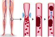درباره لخته شدن خون در وریدهای عمقی چه می دانید